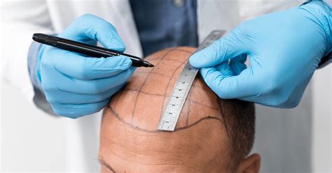 Haartransplantatie En COVID-19: Wat Zijn De Risico's?