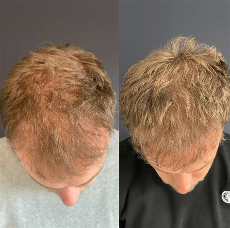 Haartransplantatie En Levensstijl: Wat Te Veranderen?