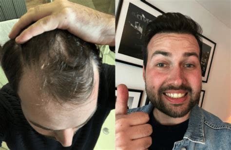 Haartransplantatie Trends Voor 2024