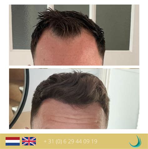 Hoe Te Duren Na Een DHI Of FUE Haartransplantatie?
